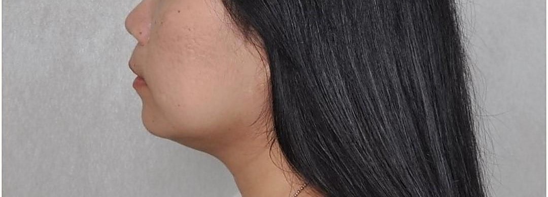 Chin & neck after 2 treatments
