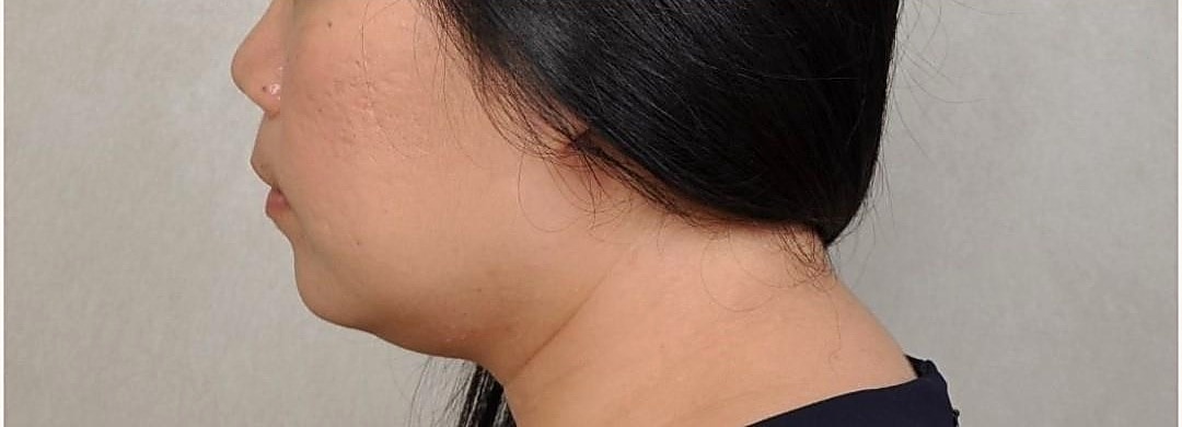 Chin & neck before treatment